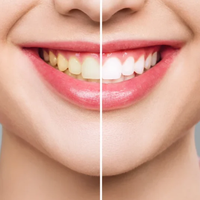 רצועות להלבנת שיניים, מדבקות להלבנת שיניים 28 יחידות- White Pro