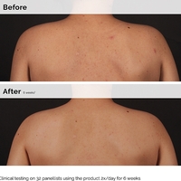 The Ordinary Salicylic Acid 0.5% Body Serum – סרום חומצה סליצילית לגוף לטיפול בפגמי עור, אקנה וחידוש המרקם (240ml