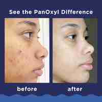 PanOxyl Acne Foaming Wash – תרחיץ מקציף לטיפול באקנה (10% בנזואיל פרוקסיד) בחוזק מקסימלי לפנים ולגוף – 28 גרם