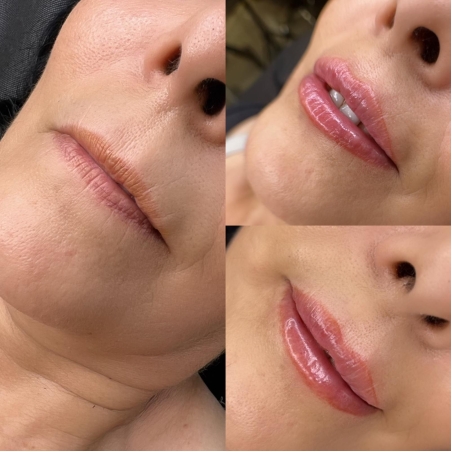 מילוי שפתיים ללא כאבים וללא מחטים  עט הילאורוני