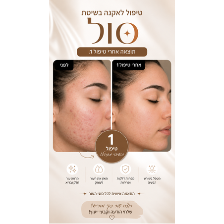 אקנה