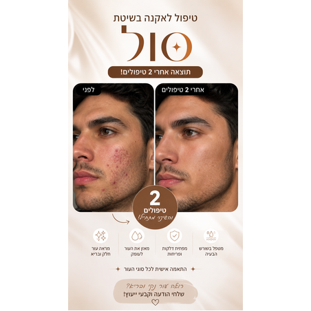 תוצאות אקנה