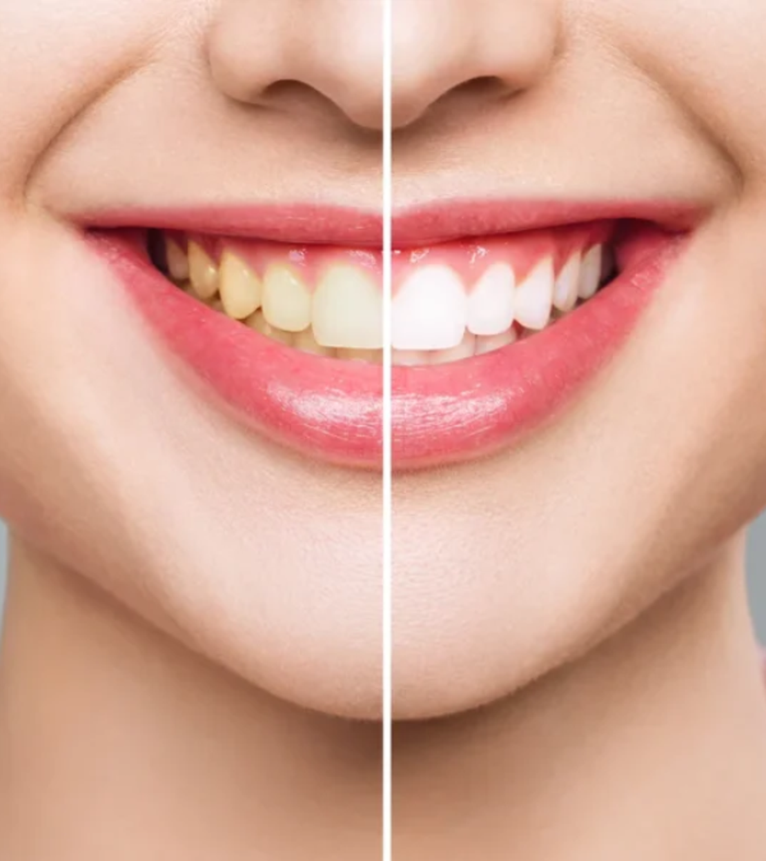 רצועות להלבנת שיניים, מדבקות להלבנת שיניים 28 יחידות- White Pro