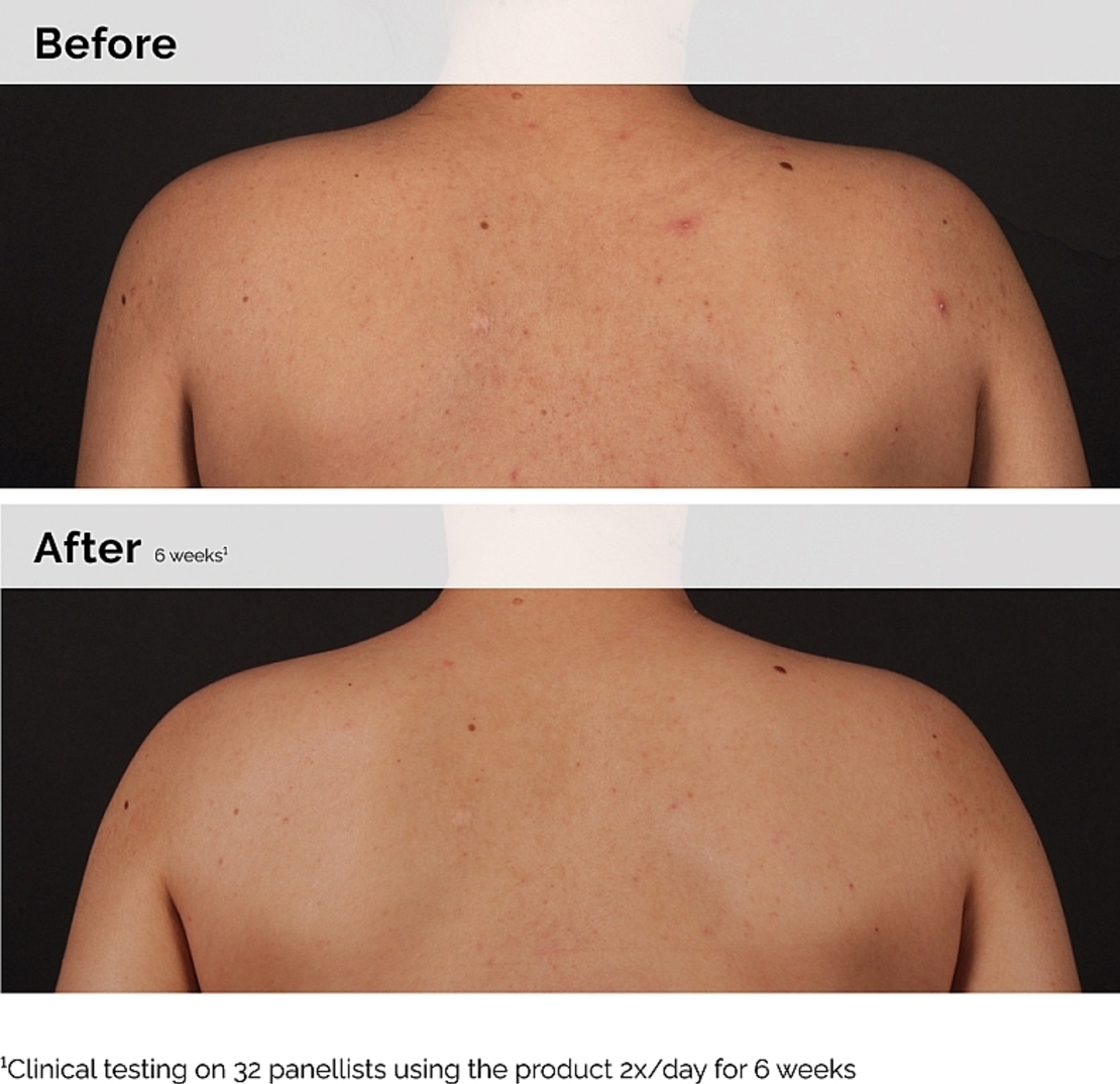 The Ordinary Salicylic Acid 0.5% Body Serum – סרום חומצה סליצילית לגוף לטיפול בפגמי עור, אקנה וחידוש המרקם (240ml