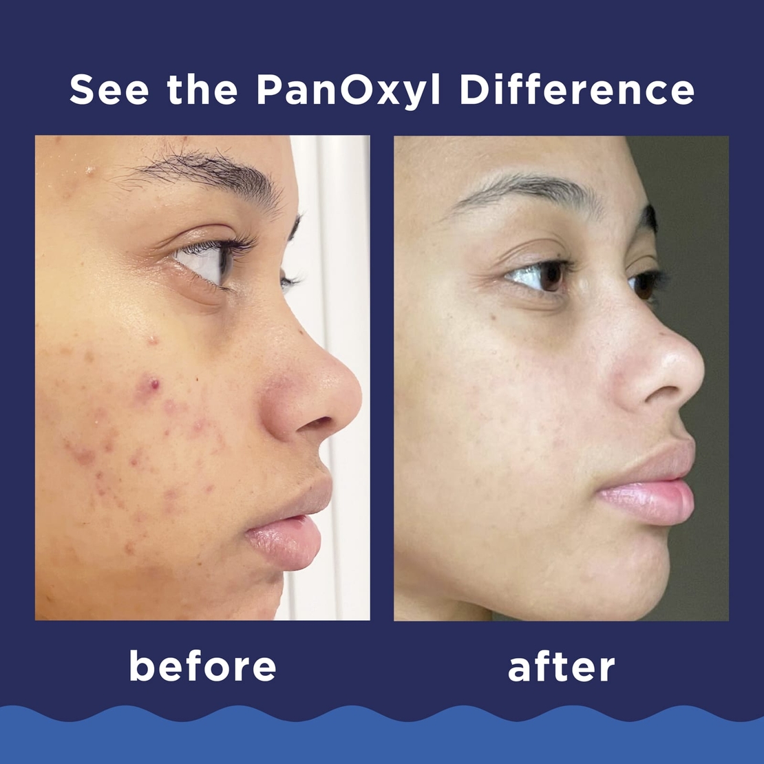 PanOxyl Acne Foaming Wash – תרחיץ מקציף לטיפול באקנה (10% בנזואיל פרוקסיד) בחוזק מקסימלי לפנים ולגוף – 28 גרם
